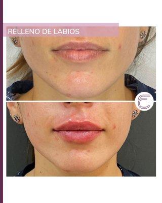 Rellenos de Labios Valencia